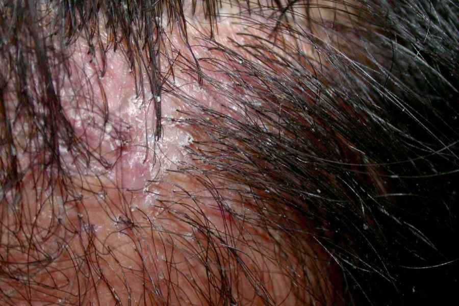 WHAT DOES SCALP folliculitis LOOK LIKE