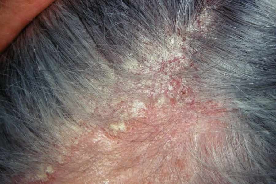  seborrheic dermatitis SCALP