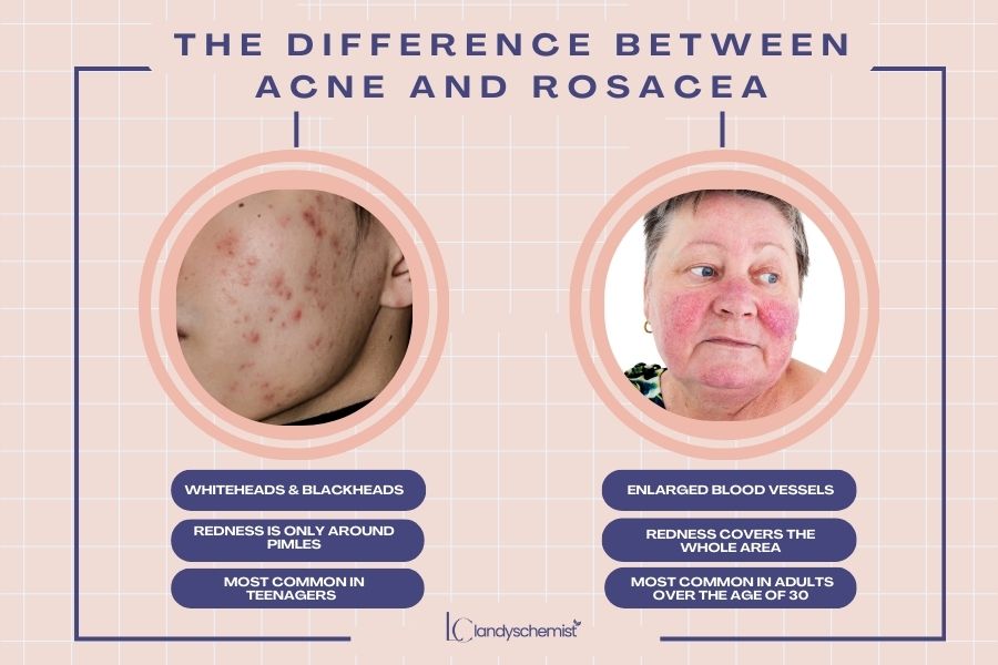 The difference between acne and rosacea