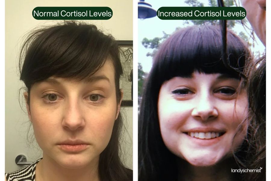 Cortisol Face Before and After